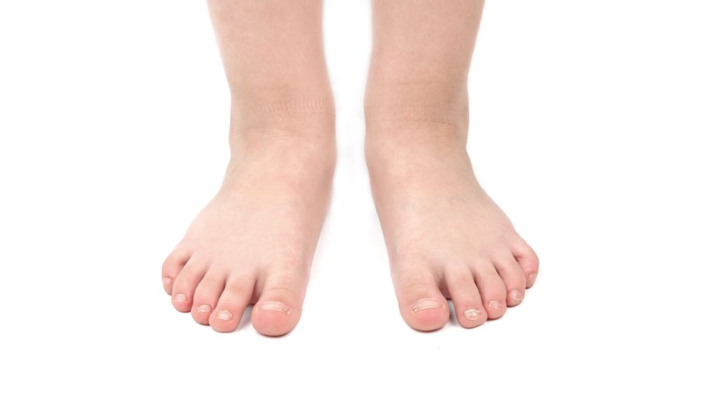 child feet showing flat foot structure which may cause fatigue or discomfort during walking
