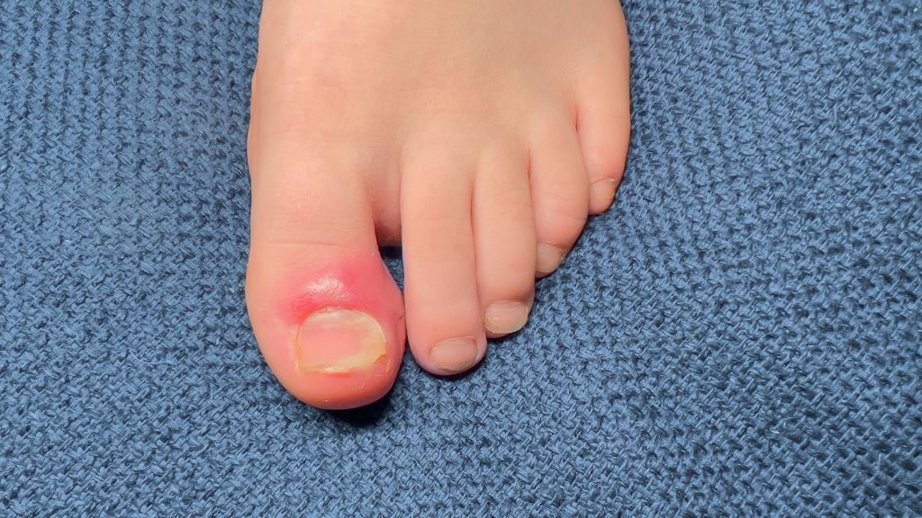child toe with ingrown toenail redness and swelling requiring podiatry care