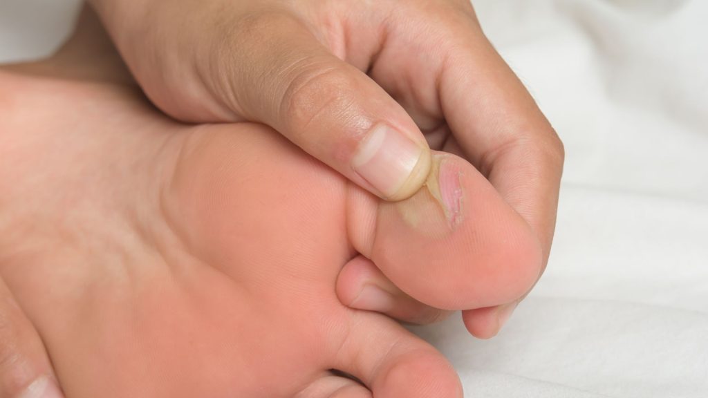 Close-up of blister on runner’s foot caused by friction during long distance running
