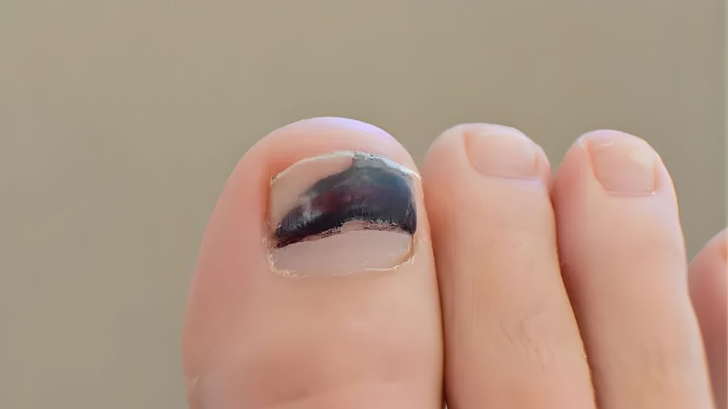 Runner’s toenail showing bruising caused by repeated pressure inside running shoes during long distance runs