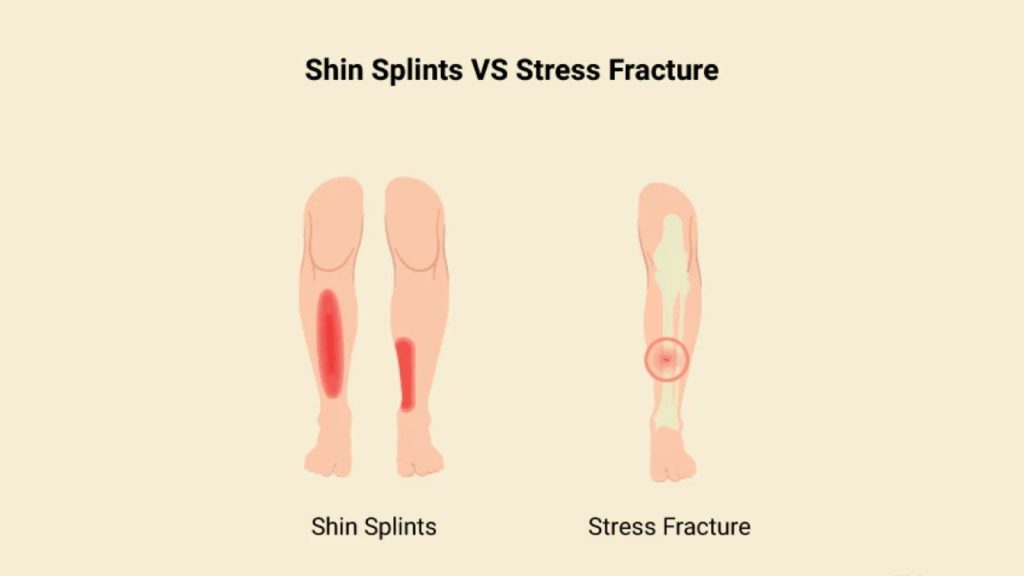 Illustration comparing shin splints vs stress fracture pain areas.
